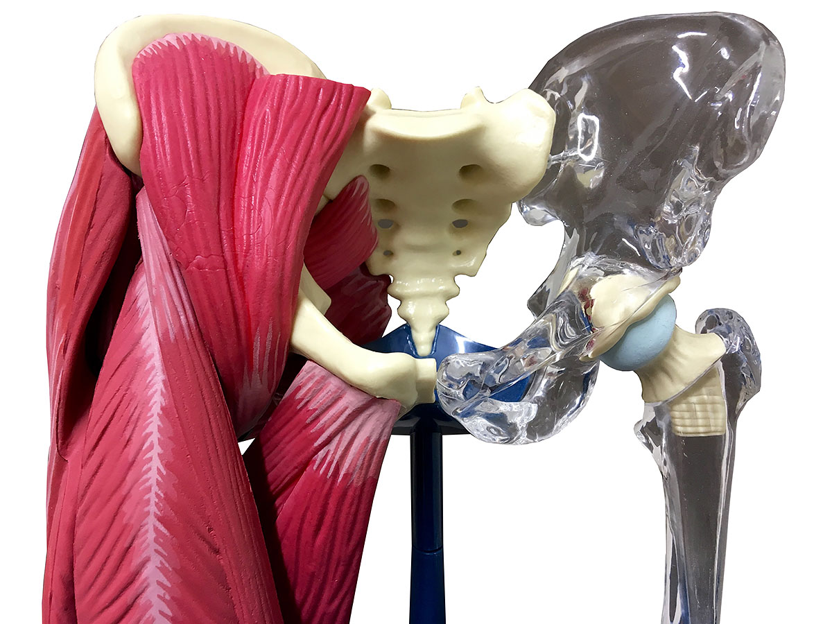 Замена тазобедренного сустава как проходит операция. Артропластика тазобедренного сустава. Эндопротезирование тазобедренного сустава. Эндопротез ТБС.